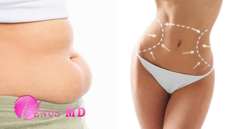 Liposuction: An Effective Fat Removal Method for a Better Body Shape