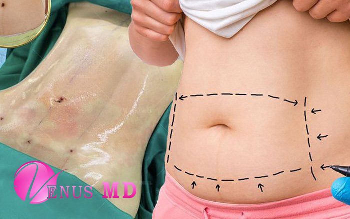 Liposuction: Everything You Need to Know