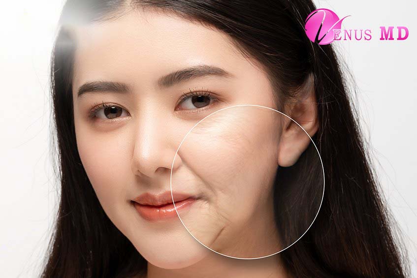 What Is Nasolabial Fold Filler Injection? Benefits, Procedure, and Risks