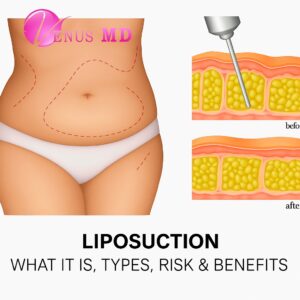 Liposuction: What It Is, How It Works, Benefits & Recovery