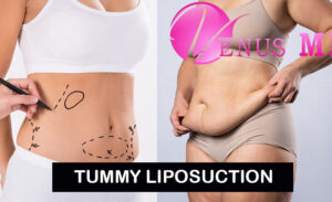 Tummy Liposuction - Venus MD