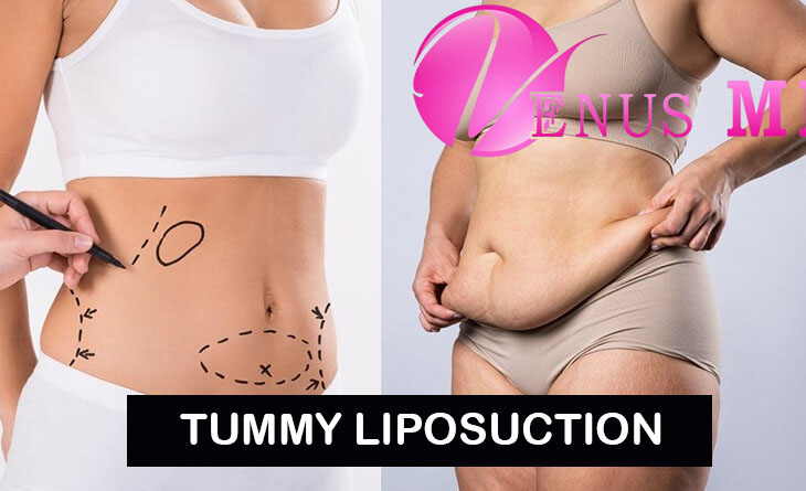 Tummy Liposuction - Venus MD