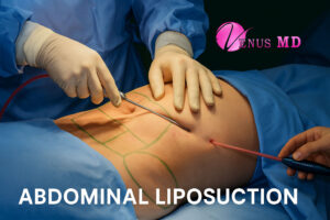 abdominal liposuction - Venus MD