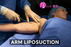 arm liposuction - Venus MD