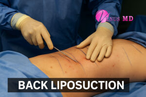 back liposuction - Venus MD