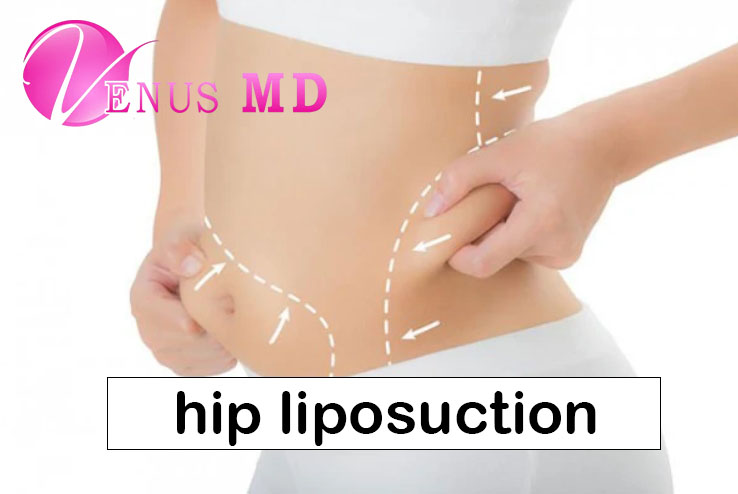 hip liposuction - Venus MD