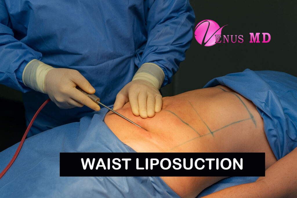 waist liposuction - Venus MD