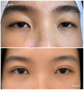Before and after Asian upper eyelid surgery showing reduced hooding and a wider eyelid crease at VENUS MD