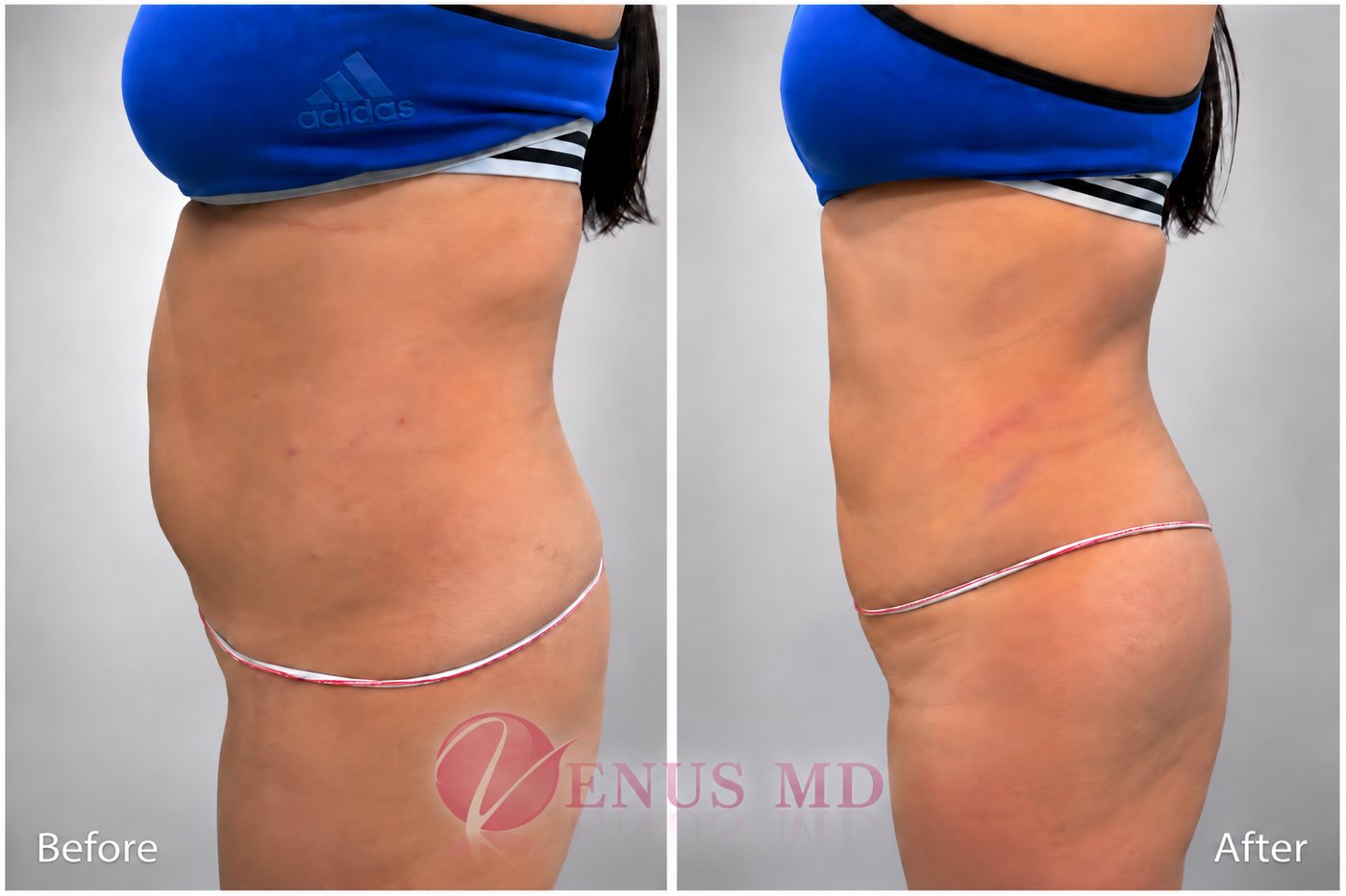 Abdomen liposuction before and after - VENUS MD Orange County