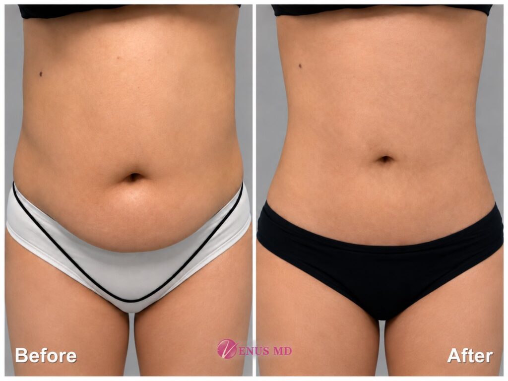 Front abdomen liposuction before and after - VENUS MD Orange County